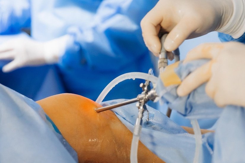 Joint Replacement Surgery1